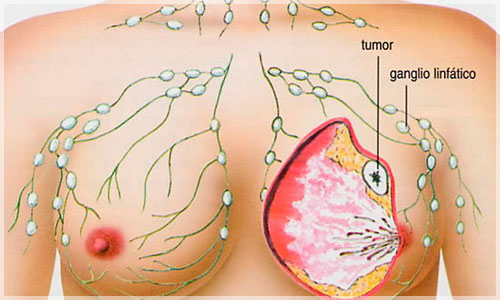 CANCER-DE-maa-HMTV-Noticias