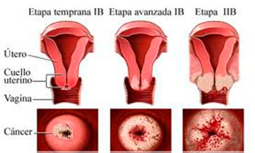 El-virus-de-Papiloma-y-Cancer