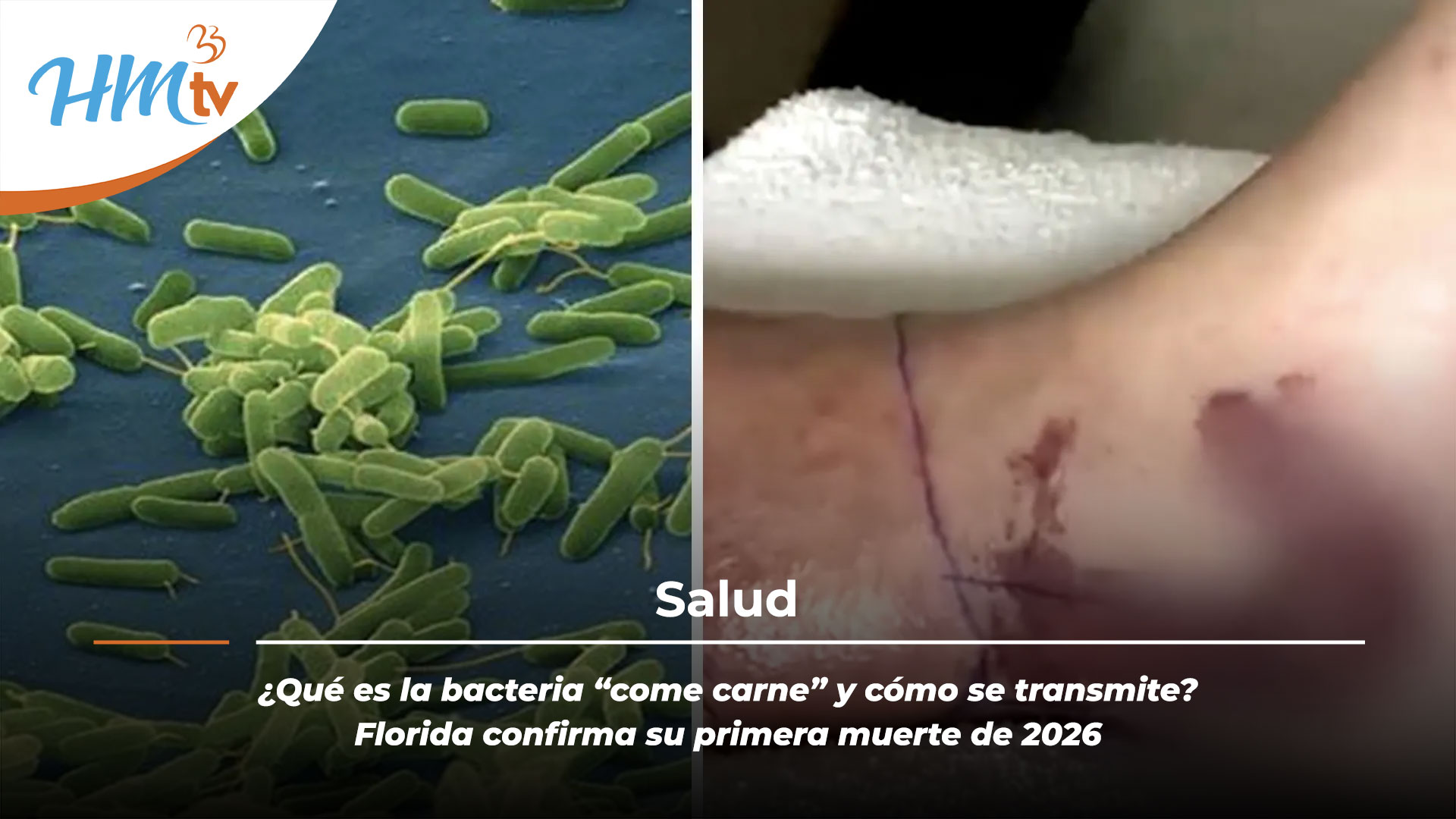 ¿Qué es la bacteria “come carne” y cómo se transmite? Florida confirma su primera muerte de 2026